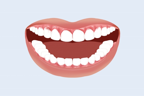 戴牙套的好处和坏处
