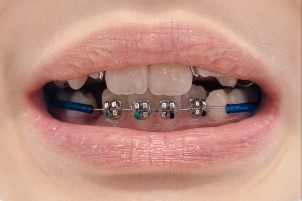 戴牙套的好处和坏处