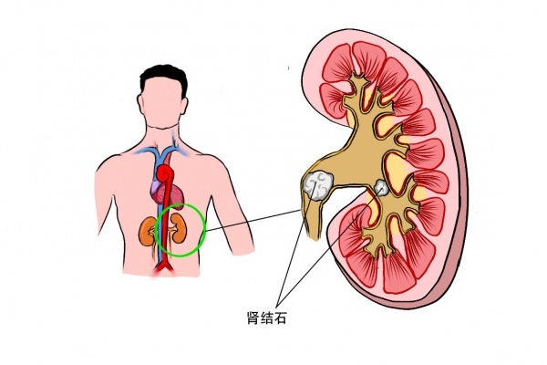 肾疼是什么症状