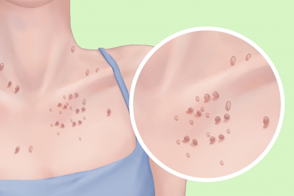 感染HPV有什么症状表现