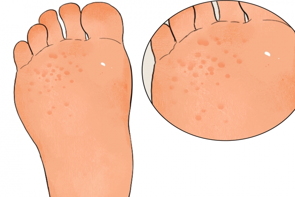 女人脚底出汗是湿气吗