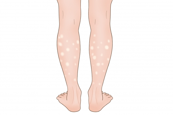 腿上起白色皮屑是什么原因