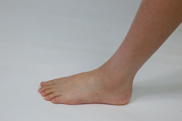 脚跟开裂是什么原因