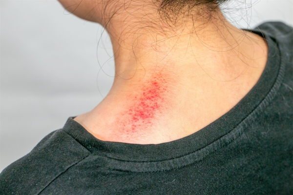 刮痧后需要注意什么